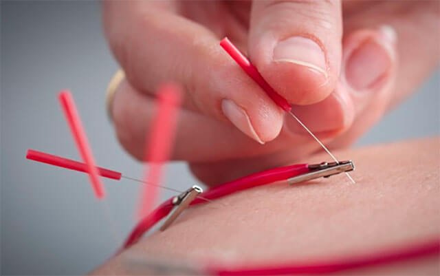 What Is Electroacupuncture